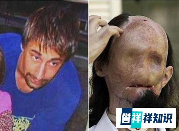 烧伤奇迹—震惊世界的面部移植