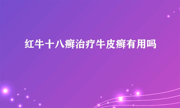红牛十八癣治疗牛皮癣有用吗