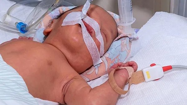 婴儿母乳性腹泻如何治疗