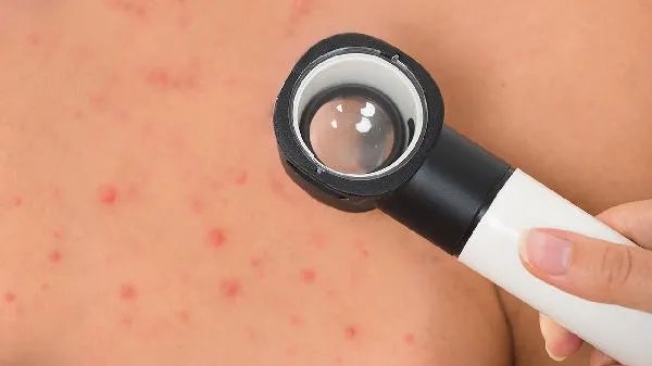 吃感康过敏了什么症状
