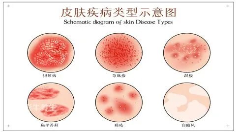 寒冷性荨麻疹治疗