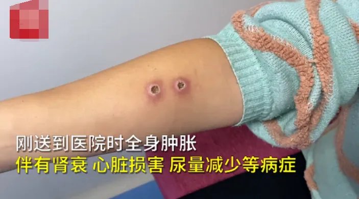 一家三口采板栗被胡蜂蜇伤，情况如何？