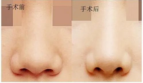 鼻翼肥大整形多少钱	