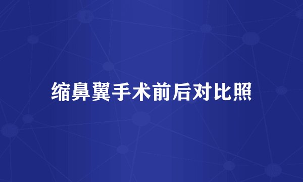 缩鼻翼手术前后对比照