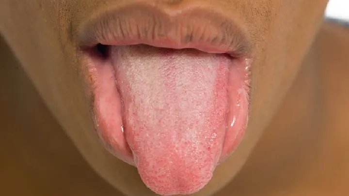 舌病如何预防