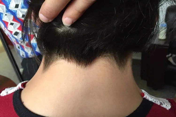 儿童颈蹼图片