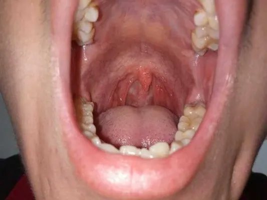 治疗咳嗽的最快方法有哪些？