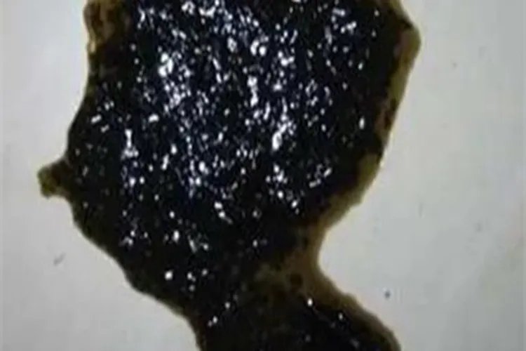炭疽病腹部症状图片