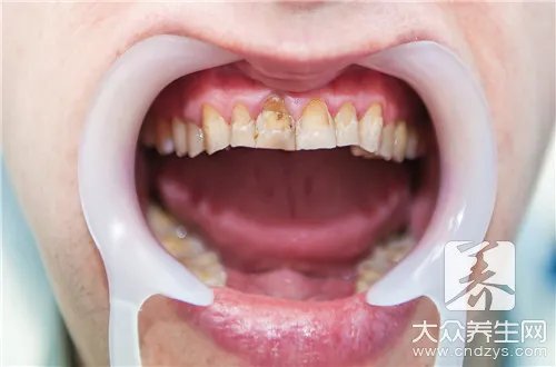 四环素牙不同程度图片
