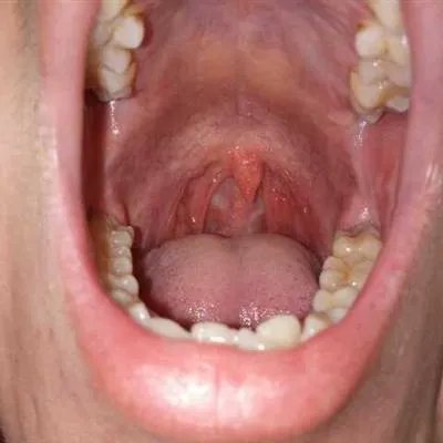 舌根有疙瘩是怎么回事?