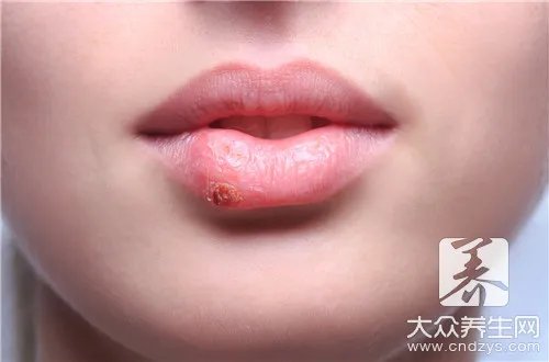 唇炎挂什么科彻底治好