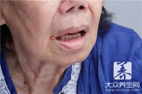 唇炎挂什么科彻底治好
