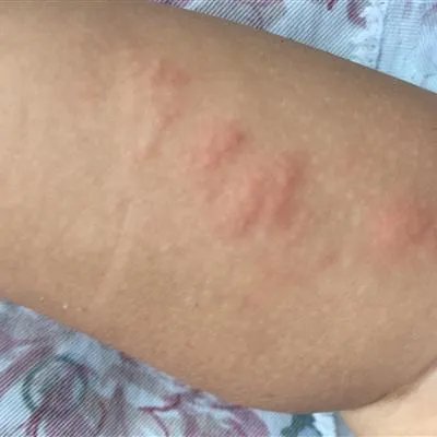 疥疮有什么症状?