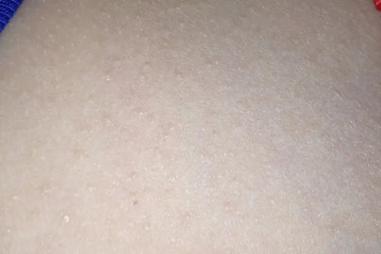 新生儿湿疹和痱子的区别图片