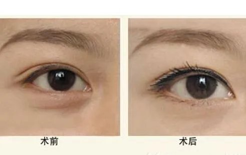 激光祛眼袋效果好不好