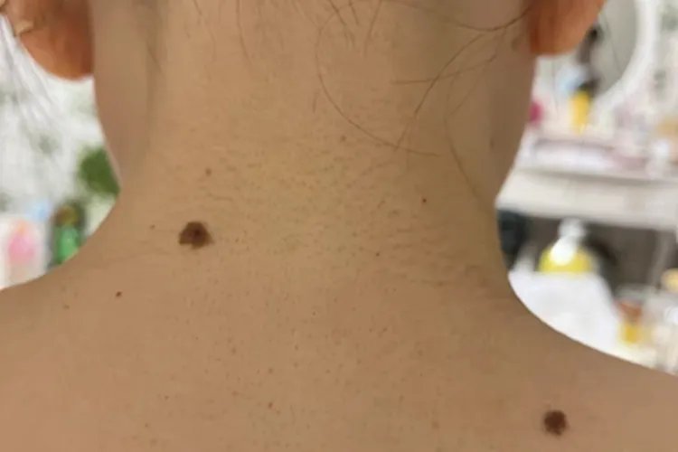 交界痣后颈症状图片