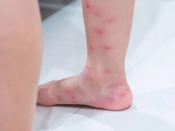 家里有咬人的蚂蚁怎么办