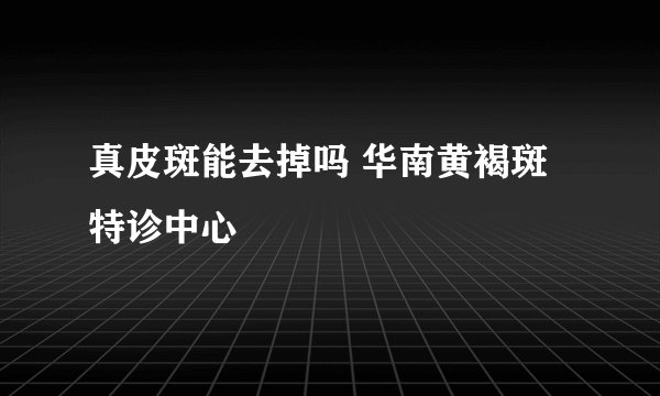 真皮斑能去掉吗 华南黄褐斑特诊中心