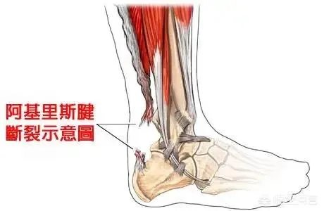 杜兰特G5复出再次受伤,勇士管理层真的不了解杜兰特伤情吗?