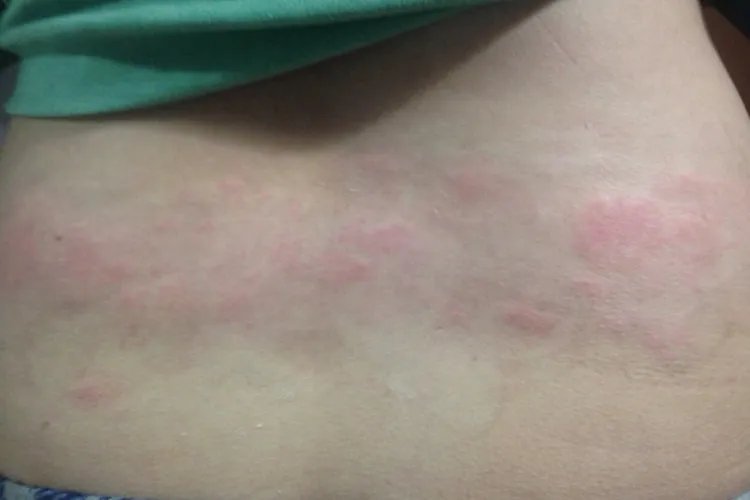 女性身体两侧起小红疹子很痒图片