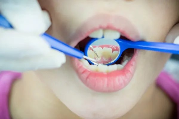 冷光美白牙齿价格大概多少左右