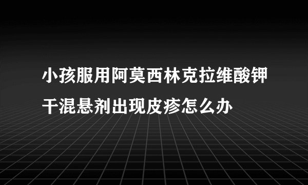 小孩服用阿莫西林克拉维酸钾干混悬剂出现皮疹怎么办