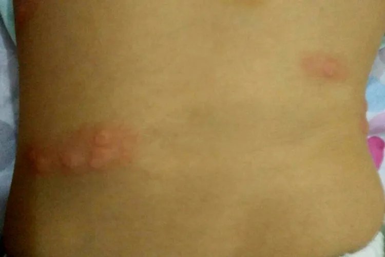 女性身体两侧起小红疹子很痒图片