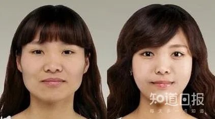 可怕吗？下颌角磨骨削骨手术的原理和过程
