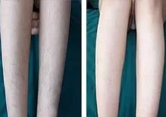 彩光脱毛的副作用是什么