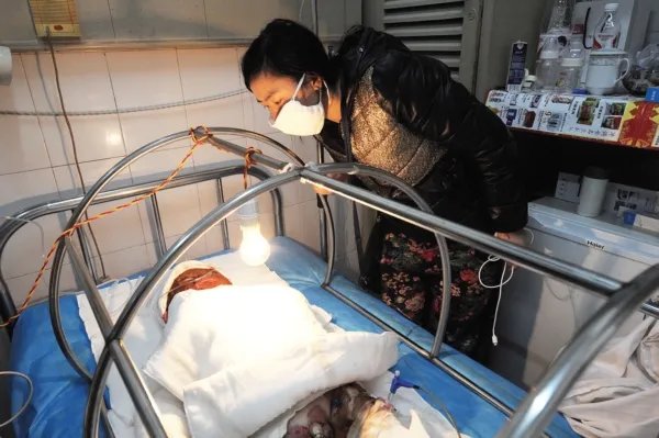 河北石家庄女孩玩火碱重度烧伤,单亲妈妈泪崩,这种烧伤是否可以治疗?
