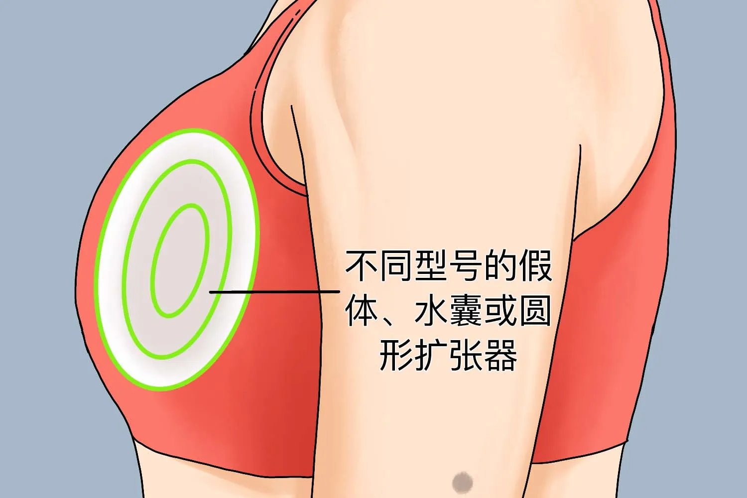 假体隆胸测量正确方法图片