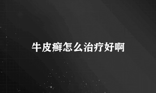 牛皮癣怎么治疗好啊