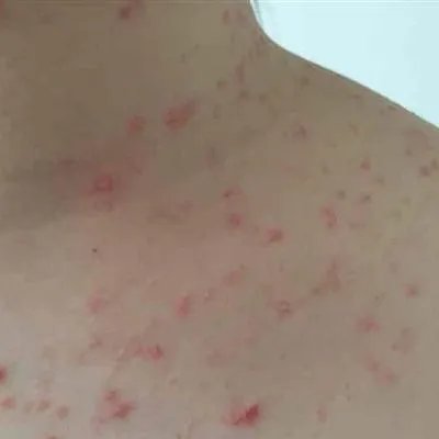 最快祛痘方法