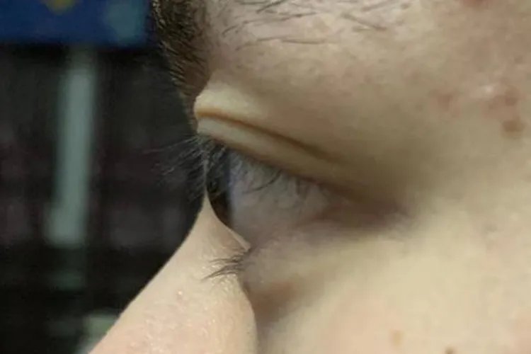 青少年近视图片