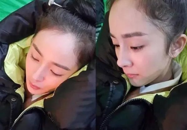 杨幂发际线为什么这么高?