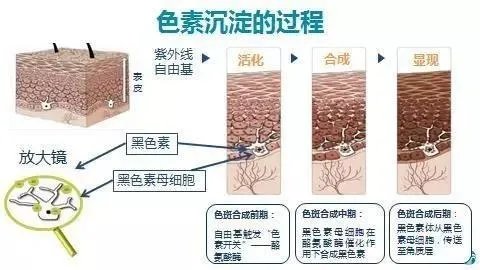 色斑能去掉吗