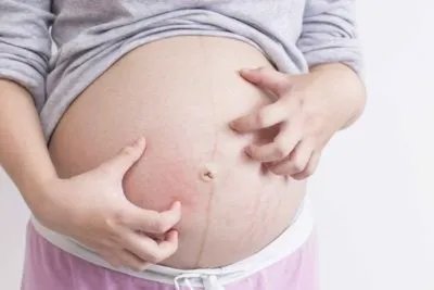 春季孕妈如何防过敏 盘点春季过敏体质孕妇防过敏小常识