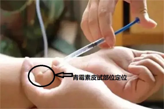 青霉素皮试部位定位图