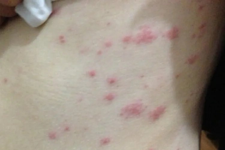 女性身体两侧起小红疹子很痒图片